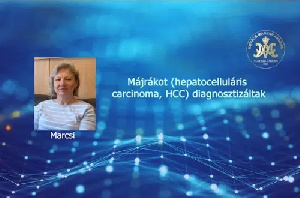 Májrákot (hepatocelluláris carcinoma, HCC) diagnosztizáltak